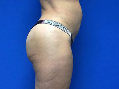 Brazilian Butt Lift Before & After Gallery - Patient 55042894 - Image 10