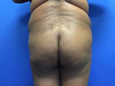 Brazilian Butt Lift Before & After Gallery - Patient 55042895 - Image 1
