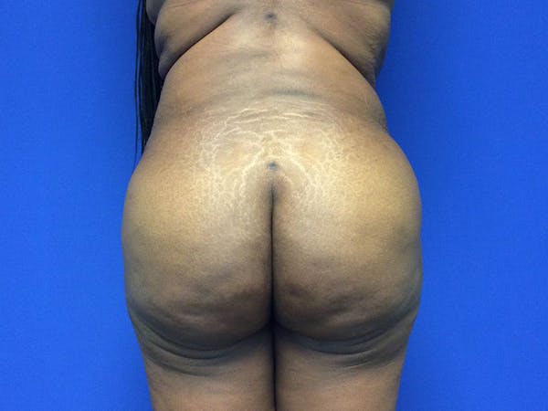 Brazilian Butt Lift Before & After Gallery - Patient 55042895 - Image 2