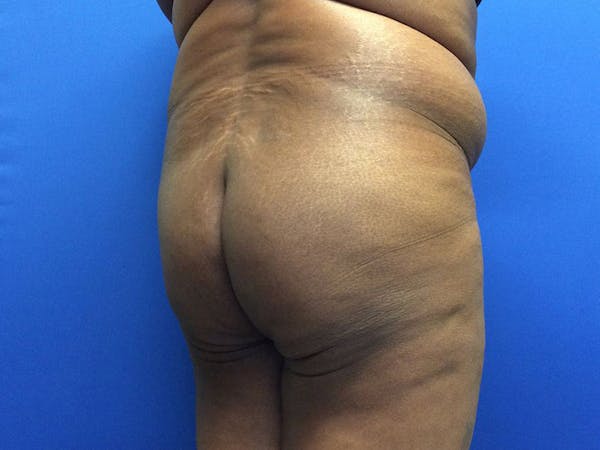 Brazilian Butt Lift Before & After Gallery - Patient 55042895 - Image 3