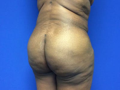 Brazilian Butt Lift Before & After Gallery - Patient 55042895 - Image 4