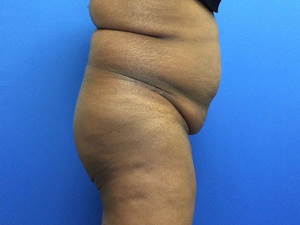 Brazilian Butt Lift Gallery - Patient 55042895 - Image 5
