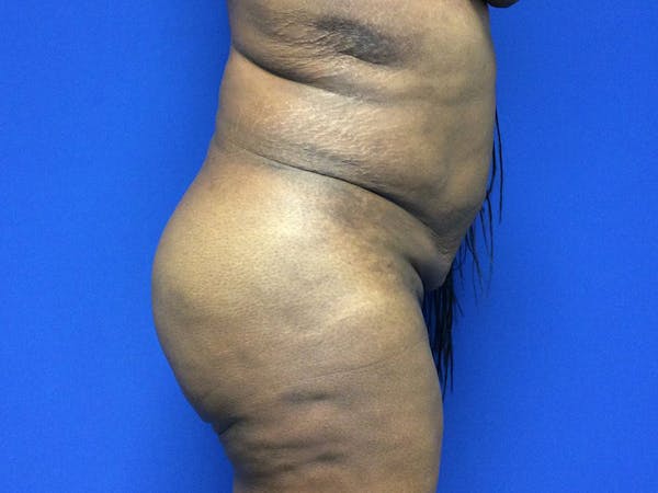Brazilian Butt Lift Gallery - Patient 55042895 - Image 6