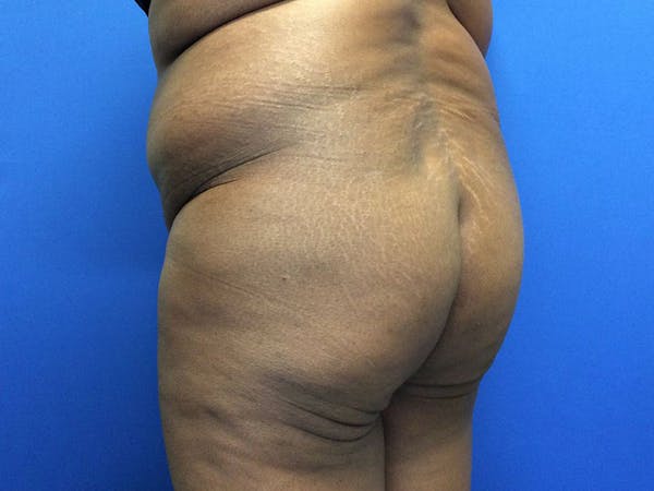 Brazilian Butt Lift Gallery - Patient 55042895 - Image 7
