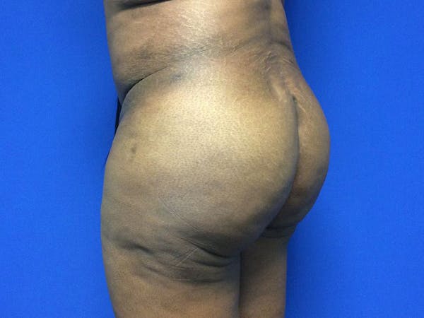 Brazilian Butt Lift Before & After Gallery - Patient 55042895 - Image 8