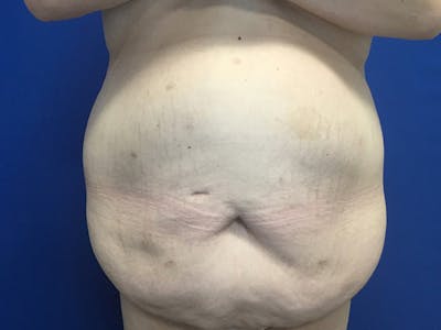 Tummy Tuck (Abdominoplasty) Before & After Gallery - Patient 58469936 - Image 1