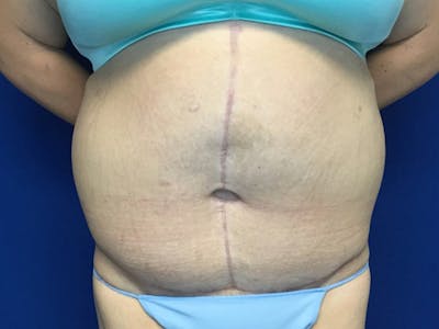 Tummy Tuck (Abdominoplasty) Before & After Gallery - Patient 58469936 - Image 2