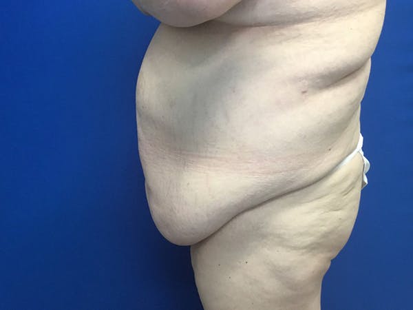 Tummy Tuck (Abdominoplasty) Before & After Gallery - Patient 58469936 - Image 3