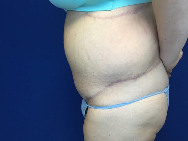 Tummy Tuck (Abdominoplasty) Before & After Gallery - Patient 58469936 - Image 4