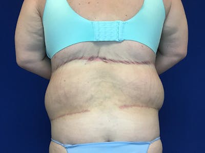 Tummy Tuck (Abdominoplasty) Before & After Gallery - Patient 58469936 - Image 6