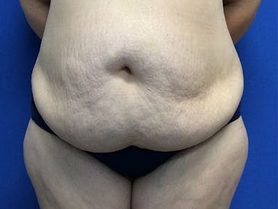 Tummy Tuck (Abdominoplasty) Before & After Gallery - Patient 60071314 - Image 1