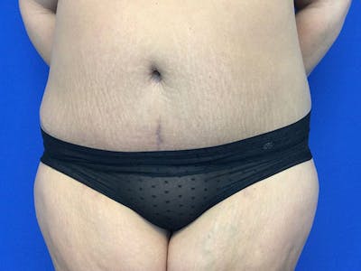 Tummy Tuck (Abdominoplasty) Before & After Gallery - Patient 60071314 - Image 2