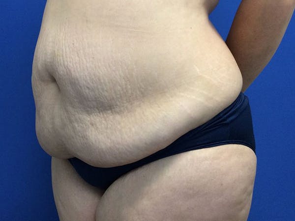 Tummy Tuck (Abdominoplasty) Before & After Gallery - Patient 60071314 - Image 3