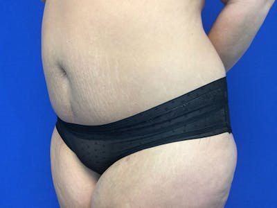 Tummy Tuck (Abdominoplasty) Gallery - Patient 60071314 - Image 4