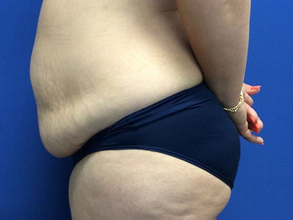 Tummy Tuck (Abdominoplasty) Before & After Gallery - Patient 60071314 - Image 5