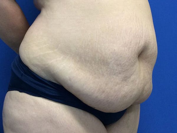 Tummy Tuck (Abdominoplasty) Before & After Gallery - Patient 60071314 - Image 7