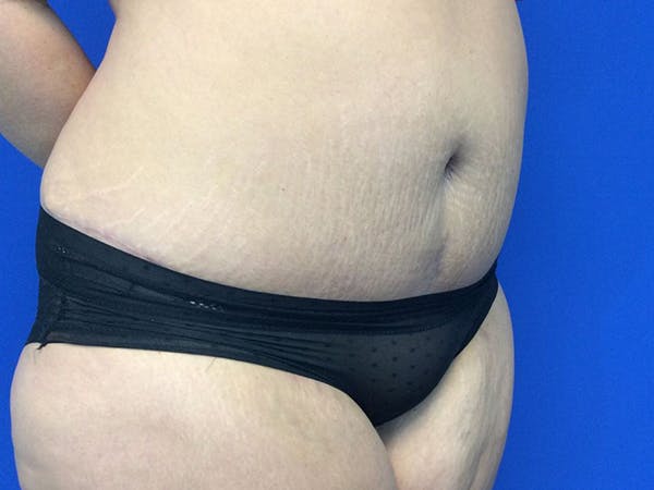 Tummy Tuck (Abdominoplasty) Before & After Gallery - Patient 60071314 - Image 8