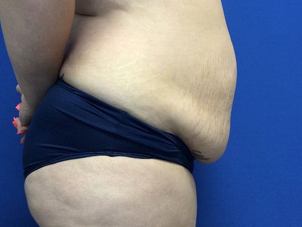 Tummy Tuck (Abdominoplasty) Before & After Gallery - Patient 60071314 - Image 9