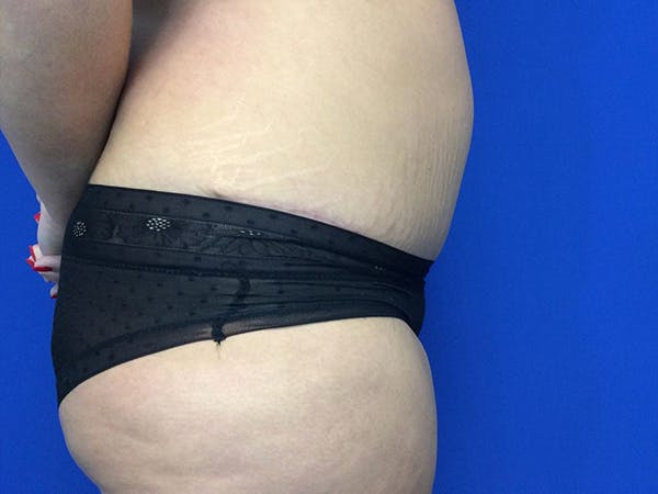 Tummy Tuck (Abdominoplasty) Before & After Gallery - Patient 60071314 - Image 10