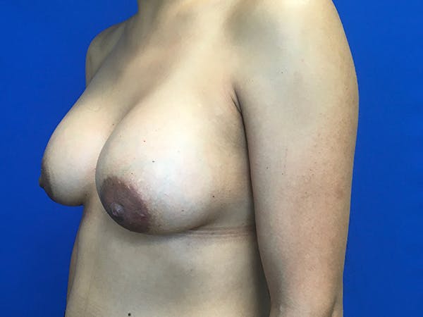 Breast Augmentation Before & After Gallery - Patient 62096004 - Image 4