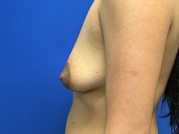 Breast Augmentation Before & After Gallery - Patient 62096004 - Image 5