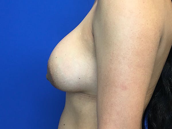 Breast Augmentation Before & After Gallery - Patient 62096004 - Image 6