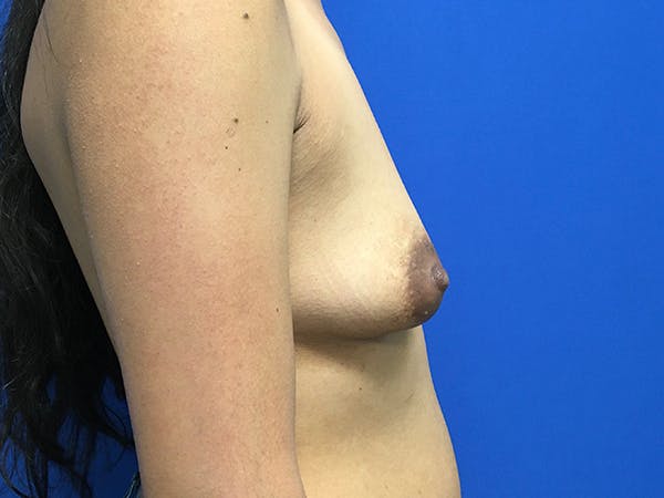 Breast Augmentation Before & After Gallery - Patient 62096004 - Image 7