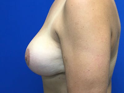 Mastopexy Before & After Gallery - Patient 62194399 - Image 6
