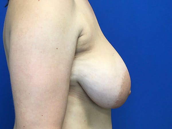 Mastopexy Before & After Gallery - Patient 62194399 - Image 7
