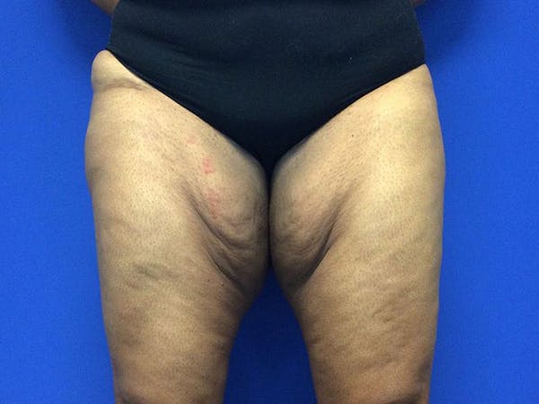 Thigh Lift Before & After Gallery - Patient 62194421 - Image 1