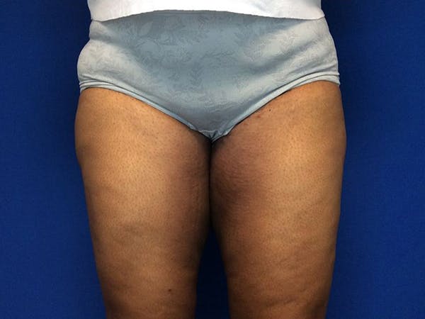 Thigh Lift Before & After Gallery - Patient 62194421 - Image 2