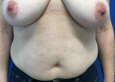 Liposuction Before & After Gallery - Patient 4910308 - Image 1