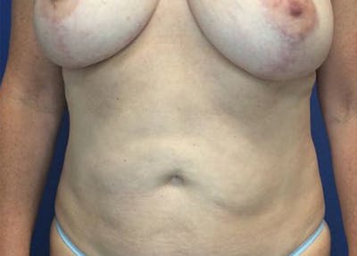 Liposuction Before & After Gallery - Patient 4910308 - Image 2