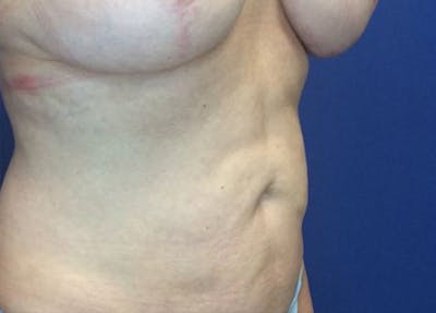 Liposuction Before & After Gallery - Patient 4910308 - Image 4
