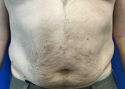 Liposuction Before & After Gallery - Patient 5555905 - Image 1