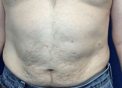 Liposuction Before & After Gallery - Patient 5555905 - Image 2