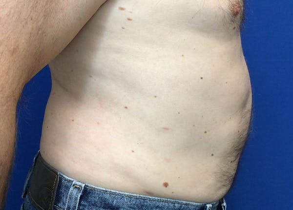 Liposuction Before & After Gallery - Patient 5555905 - Image 4
