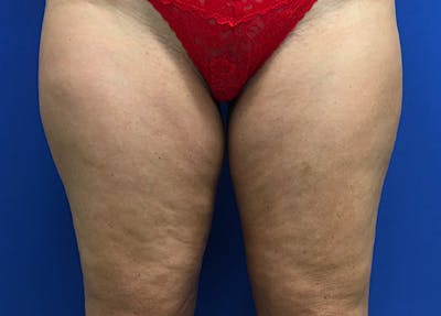 Liposuction Before & After Gallery - Patient 5910742 - Image 1