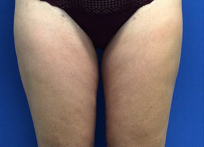 Liposuction Before & After Gallery - Patient 5910742 - Image 2