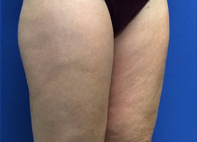 Liposuction Before & After Gallery - Patient 5910742 - Image 4