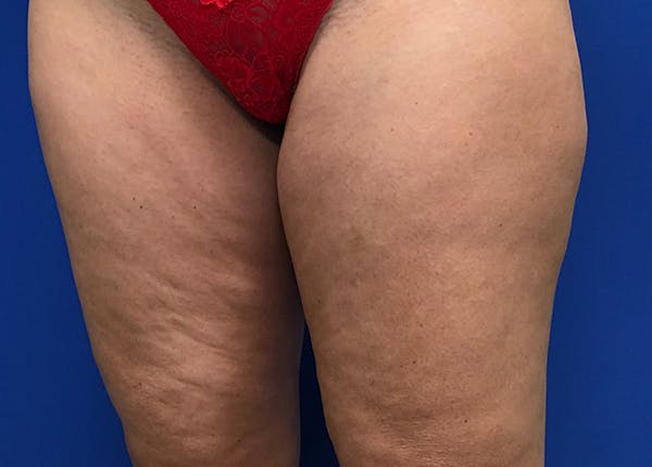 Liposuction Before & After Gallery - Patient 5910742 - Image 5