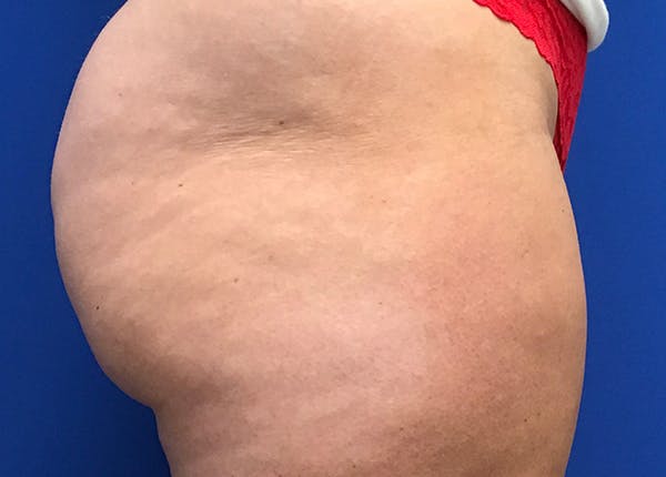 Liposuction Before & After Gallery - Patient 5910742 - Image 7