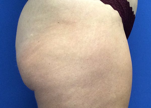 Liposuction Before & After Gallery - Patient 5910742 - Image 8