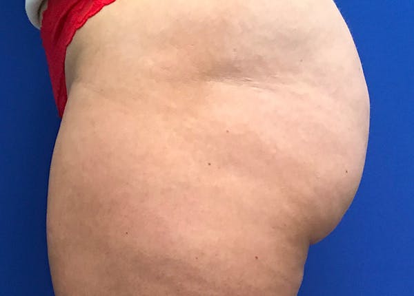 Liposuction Before & After Gallery - Patient 5910742 - Image 9