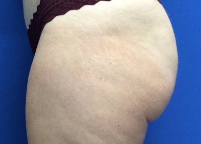 Liposuction Before & After Gallery - Patient 5910742 - Image 10