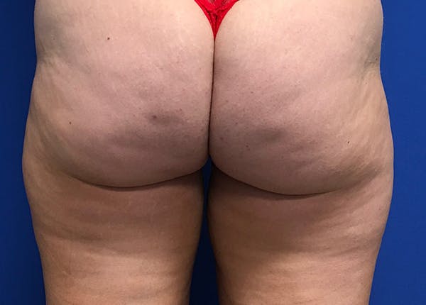 Liposuction Before & After Gallery - Patient 5910742 - Image 11