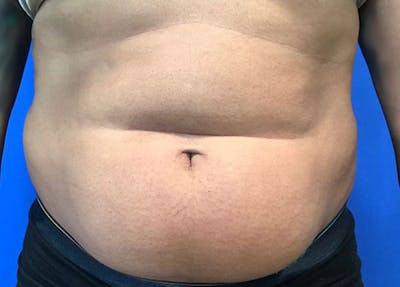 Liposuction Before & After Gallery - Patient 45225183 - Image 1