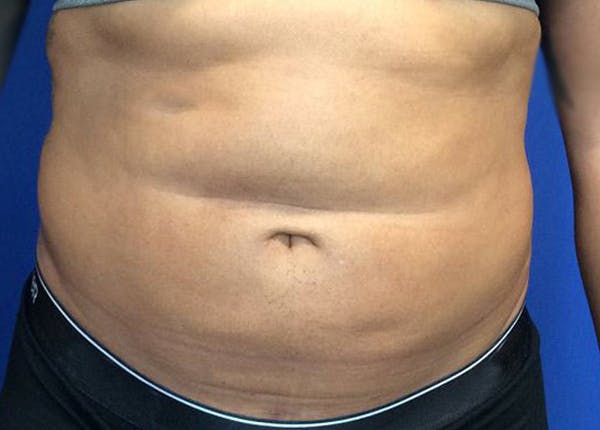 Liposuction Gallery - Patient 45225183 - Image 2