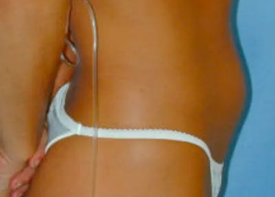 Liposuction Before & After Gallery - Patient 4726796 - Image 1