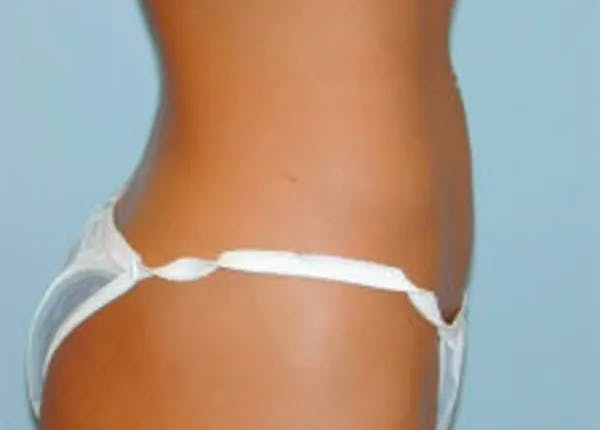 Liposuction Before & After Gallery - Patient 4726796 - Image 2